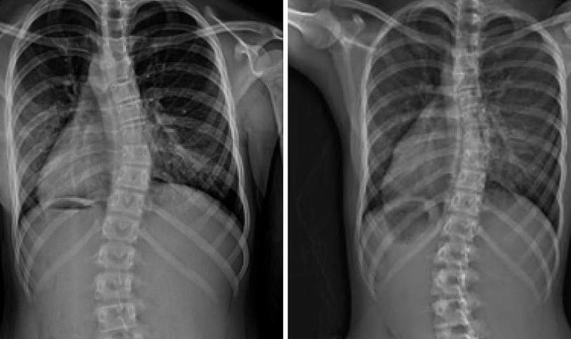 LWL | Sports and Scoliosis: Is scoliosis affected negatively or positively by certain physical activities?
