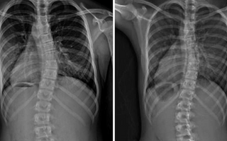 LWL | Sports and Scoliosis: Is scoliosis affected negatively or positively by certain physical activities?