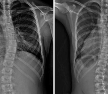 LWL | Sports and Scoliosis: Is scoliosis affected negatively or positively by certain physical activities?