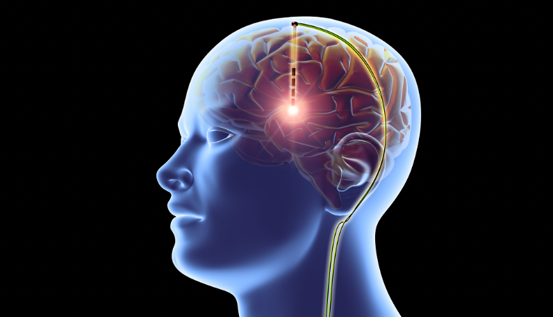 LWL | Brain Implant Maintain Memories