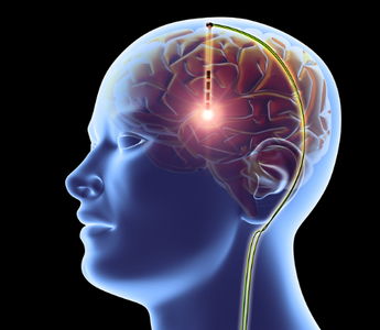 LWL | Brain Implant Maintain Memories